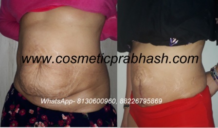 Mini tummy tuck in delhi lipoabdominoplasty india dr prabhash