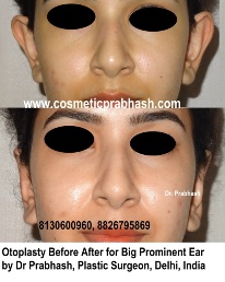 Big Ear Best Otoplasty Surgery in Delhi