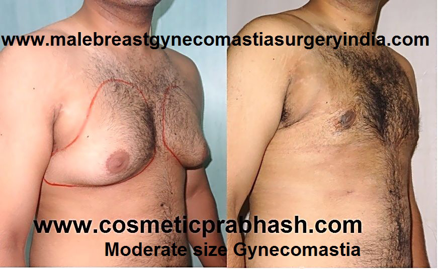 Gynecomastia India on X: The goal of #gynecomastia treatment is to reduce breast  size in men who are embarrassed by overly large breasts. Reduction methods  include #liposuction, cutting out excess glandular tissue