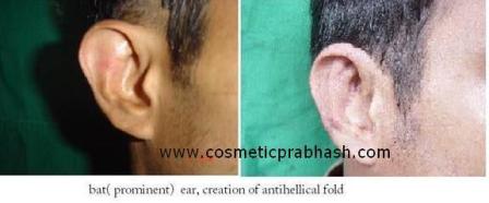 Otoplasty Delhi Ear Reshaping Surgery India