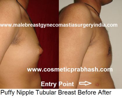 puffy nipple grade 1 gynecomastia surgery before after India Dr Prabhash Delhi