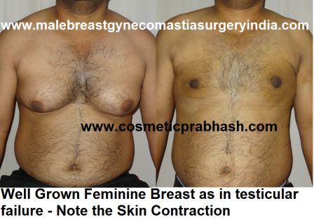 gynecomastia surgery before after low testosterone India Dr Prabhash Delhi